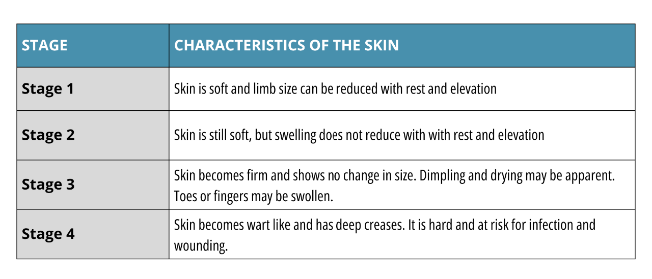 Image of a chart describing the 4 stages of Lymphedema